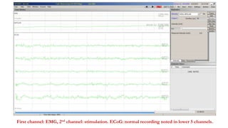 First channel: EMG, 2nd channel: stimulation. ECoG: normal recording noted in lower 5 channels.
 