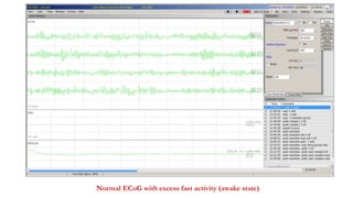 Normal ECoG with excess fast activity (awake state)
 