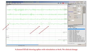 4 channel ECoG showing spikes with stimulation at 4mA. No clinical change
 