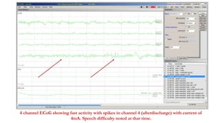 4 channel ECoG showing fast activity with spikes in channel 4 (afterdischarge) with current of
4mA. Speech difficulty noted at that time.
 