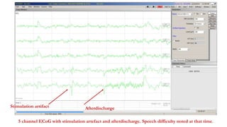 Stimulation artifact Afterdischarge
5 channel ECoG with stimulation artefact and afterdischarge. Speech difficulty noted at that time.
 