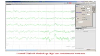 5 channel ECoG with afterdischarge. Right hand numbness noted at that time.
 