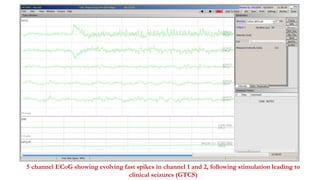 5 channel ECoG showing evolving fast spikes in channel 1 and 2, following stimulation leading to
clinical seizures (GTCS)
 