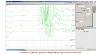 5 channel ECoG with generalised spikes following cortical stimulation.
 
