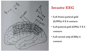 Invasive EEG
• Left fronto parietal grid
(LFPG): 8 X 4 contacts
• Left parietal grid (LPG): 5 X 4
contacts
• Left mesial strip (LMS): 6
contacts
 