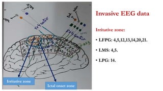 Invasive EEG data
Irritative zone:
• LFPG: 4,5,12,13,14,20,21.
• LMS: 4,5.
• LPG: 14.
Ictal onset zone
Irritative zone
 