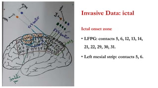 Invasive Data: ictal
Ictal onset zone
• LFPG: contacts 5, 6, 12, 13, 14,
21, 22, 29, 30, 31.
• Left mesial strip: contacts 5, 6.
 