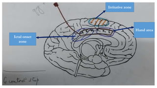 Ictal onset
zone
Hand area
Irritative zone
 