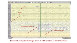 Invasive EEG: Afterdischarge noted in LPG contact 12 on stimulation.
Stimulation artifact
Afterdischarge
IEDs
 
