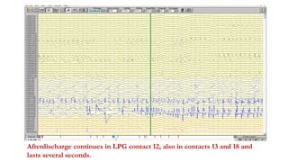 Afterdischarge continues in LPG contact 12, also in contacts 13 and 18 and
lasts several seconds.
 
