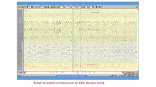 Hand movement on stimulation: no EEG changes noted.
 