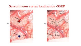P20
N20
Sensorimotor cortex localization -SSEP
P20
N20
 