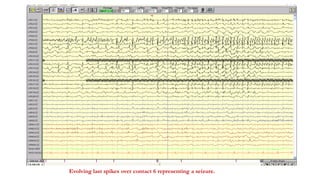 Evolving last spikes over contact 6 representing a seizure.
 