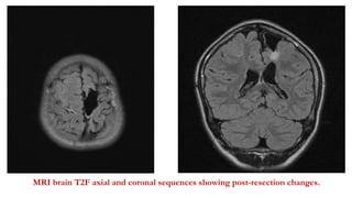 MRI brain T2F axial and coronal sequences showing post-resection changes.
 