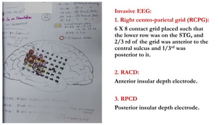 Invasive EEG:
1. Right centro-parietal grid (RCPG):
6 X 8 contact grid placed such that
the lower row was on the STG, and
2/3 rd of the grid was anterior to the
central sulcus and 1/3rd was
posterior to it.
2. RACD:
Anterior insular depth electrode.
3. RPCD
Posterior insular depth electrode.
 
