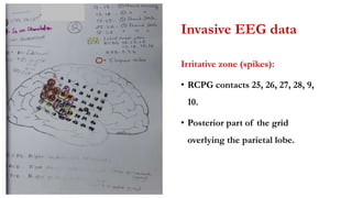 Invasive EEG data
Irritative zone (spikes):
• RCPG contacts 25, 26, 27, 28, 9,
10.
• Posterior part of the grid
overlying the parietal lobe.
 