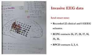 Invasive EEG data
Ictal onset zone:
• Recorded 22 clinical and 5 EEEG
seizures.
• RCPG contacts 26, 27, 28, 17, 18,
35, 36.
• RPCD contacts 2, 3, 4.
 