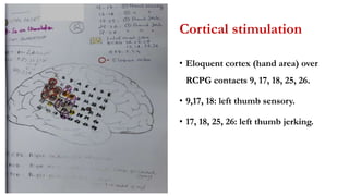 Cortical stimulation
• Eloquent cortex (hand area) over
RCPG contacts 9, 17, 18, 25, 26.
• 9,17, 18: left thumb sensory.
• 17, 18, 25, 26: left thumb jerking.
 