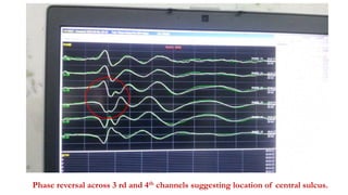 Phase reversal across 3 rd and 4th channels suggesting location of central sulcus.
 