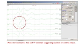 Phase reversal across 3 rd and 4th channels suggesting location of central sulcus.
 