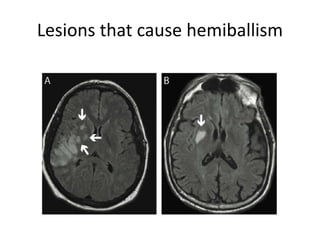 Lesions that cause hemiballism
 