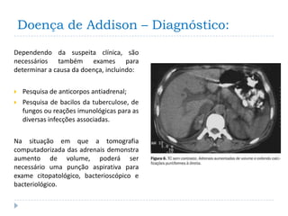Doença de Addison – Diagnóstico:

Dependendo da suspeita clínica, são
necessários também exames para
determinar a causa da doença, incluindo:


   Pesquisa de anticorpos antiadrenal;
   Pesquisa de bacilos da tuberculose, de
    fungos ou reações imunológicas para as
    diversas infecções associadas.


Na situação em que a tomografia
computadorizada das adrenais demonstra
aumento de volume, poderá ser
necessário uma punção aspirativa para
exame citopatológico, bacterioscópico e
bacteriológico.
 