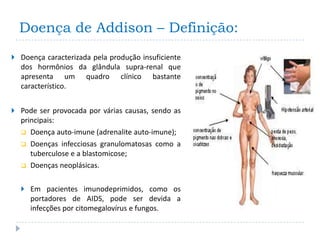 Doença de Addison – Definição:
 Doença caracterizada pela produção insuficiente
  dos hormônios da glândula supra-renal que
  apresenta um quadro clínico bastante
  característico.


 Pode ser provocada por várias causas, sendo as
  principais:
   Doença auto-imune (adrenalite auto-imune);
   Doenças infecciosas granulomatosas como a
     tuberculose e a blastomicose;
   Doenças neoplásicas.


   Em pacientes imunodeprimidos, como os
     portadores de AIDS, pode ser devida a
     infecções por citomegalovírus e fungos.
 