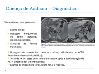 Doença de Addison – Diagnóstico:

São realizados, principalmente:


   Exame clínico;
   Dosagens bioquímicas
    de     sódio,     potássio,
    creatinina e glicose;
   Atividade de Renina
    Plasmática;

    Dosagens de hormônios como o cortisol, aldosterona e ACTH
   (hormônio adrenocorticotrófico);
    Teste de ACTH: teste de estímulo do cortisol após a administração de
   ACTH sintético por via endovenosa;
    Exames de imagem do tórax, supra-renal e hipófise.
 