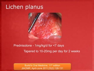Lichen planus 
Prednisolone - 1mg/kg/d for <7 days 
Tapered to 10-20mg per day for 2 weeks 
Burkit’s Oral Medicine, 11th edition 
JIAOMR, April-June 2011;23(2):128-131 
 