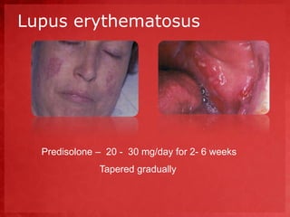 Lupus erythematosus 
Predisolone – 20 - 30 mg/day for 2- 6 weeks 
Tapered gradually 
 