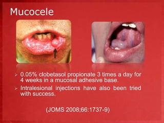 Mucocele 
 0.05% clobetasol propionate 3 times a day for 
4 weeks in a mucosal adhesive base. 
 Intralesional injections have also been tried 
with success. 
(JOMS 2008;66:1737-9) 
 