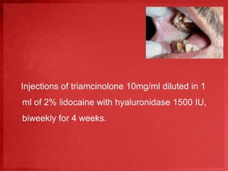 Injections of triamcinolone 10mg/ml diluted in 1 
ml of 2% lidocaine with hyaluronidase 1500 IU, 
biweekly for 4 weeks. 
 