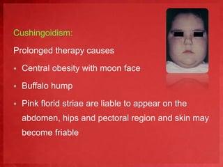 Cushingoidism: 
Prolonged therapy causes 
 Central obesity with moon face 
 Buffalo hump 
 Pink florid striae are liable to appear on the 
abdomen, hips and pectoral region and skin may 
become friable 
 