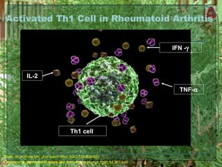 6Rheumato C Soe
Th1 cell
IFN -γ
TNF-α
IL-2
Activated Th1 Cell in Rheumatoid Arthritis
Smith JB, Haynes MK. Ann Intern Med. 2002;136:908-922
Feldmann M, Brennan FM, Maini RN. Annu Rev Immunol. 1996;14:397-440.
 