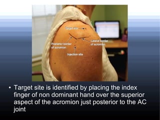 Corticosteroid injections in Orthopaedics | ODP