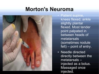 Corticosteroid injections in Orthopaedics | ODP