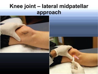Plantar fasciitis
Repetitive motion injury with inflammation in the
origin of the plantar aponeurosis at the medial
tuberc...