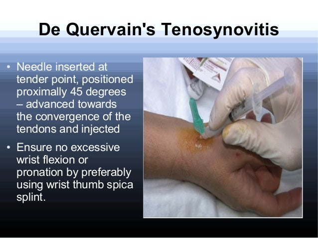 Hip Ache After Cortisone Injection The Hip Flexor
