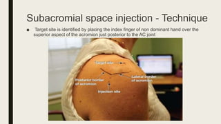 Subacromial space injection - Technique
■ Target site is identified by placing the index finger of non dominant hand over the
superior aspect of the acromion just posterior to the AC joint
 
