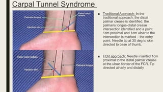 Carpal Tunnel Syndrome
■ Traditional Approach: In the
traditional approach, the distal
palmar crease is identified, the
palmaris longus-distal crease
intersection identified and a point
1cm proximal and 1cm ulnar to the
intersection is marked – the entry
point. Needle tip at 30 deg to skin
directed to base of thumb.
■ FCR approach: Needle inserted 1cm
proximal to the distal palmar crease
at the ulnar border of the FCR. Tip
directed ulnarly and distally
 