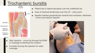 Trochanteric bursitis
■ Patient lies in lateral decubitus over the unaffected hip
■ Area of maximal tenderness over the GT – entry point
■ Needle inserted perpendicular towards the trochanter, withdrawn
1-2mm and solution injected
■ After injection – move hip through full ROM
or massage to distribute the solution.
■ Consider fanning the injection for wider
coverage.
 