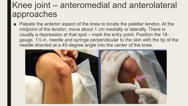 Corticosteroid injection techniques in orthopaedics | PPTX | Death ...