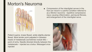 Morton's Neuroma
■ Compression of the interdigital nerves in the
foot can result in a painful condition referred to
as a Morton neuroma - repetitive compressive
injury causing inflammation, perineural fibrosis,
and enlargement of the interdigital nerve.
Patient supine, knees flexed, ankle slightly plantar
flexed. Most tender point palpated in between
heads of metatarsals (sometimes nodule felt) –
point of entry. Needle directed directly between the
metatarsals – injected as a bolus. Massaged once
injected
 