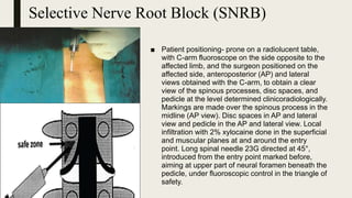 Selective Nerve Root Block (SNRB)
■ Patient positioning- prone on a radiolucent table,
with C-arm fluoroscope on the side opposite to the
affected limb, and the surgeon positioned on the
affected side, anteroposterior (AP) and lateral
views obtained with the C-arm, to obtain a clear
view of the spinous processes, disc spaces, and
pedicle at the level determined clinicoradiologically.
Markings are made over the spinous process in the
midline (AP view). Disc spaces in AP and lateral
view and pedicle in the AP and lateral view. Local
infiltration with 2% xylocaine done in the superficial
and muscular planes at and around the entry
point. Long spinal needle 23G directed at 45°,
introduced from the entry point marked before,
aiming at upper part of neural foramen beneath the
pedicle, under fluoroscopic control in the triangle of
safety.
 