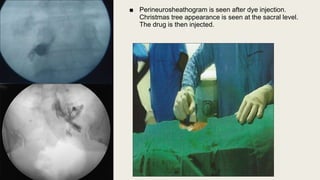 ■ Perineurosheathogram is seen after dye injection.
Christmas tree appearance is seen at the sacral level.
The drug is then injected.
 
