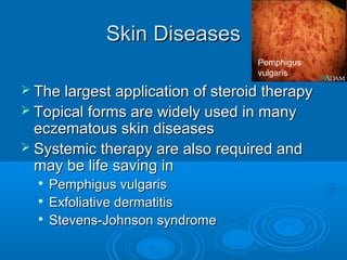 Skin DiseasesSkin Diseases
 The largest application of steroid therapyThe largest application of steroid therapy
 Topical forms are widely used in manyTopical forms are widely used in many
eczematous skin diseaseseczematous skin diseases
 Systemic therapy are also required andSystemic therapy are also required and
may be life saving inmay be life saving in

Pemphigus vulgarisPemphigus vulgaris

Exfoliative dermatitisExfoliative dermatitis

Stevens-Johnson syndromeStevens-Johnson syndrome
Pemphigus
vulgaris
 