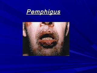 PemphigusPemphigus
 
