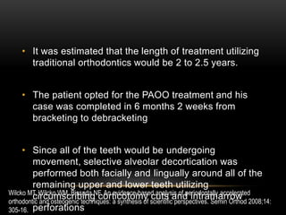 Corticotomy for Rapid Acceleration | PPTX