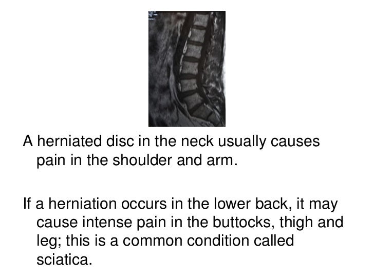 Cortisone Injections to Treat a Herniated Disc