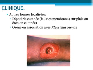 CLINIQUE.
• Autres formes localisées:
▫ Diphtérie cutanée (fausses membranes sur plaie ou
érosion cutanée)
▫ Ozène en association avec Klebsiella ozenae
 